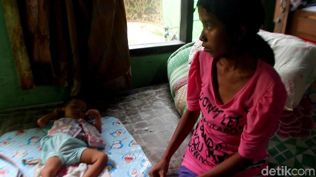 Balita 18 Bulan Penderita Gizi Buruk di Brebes Ini Bobotnya 5 Kg