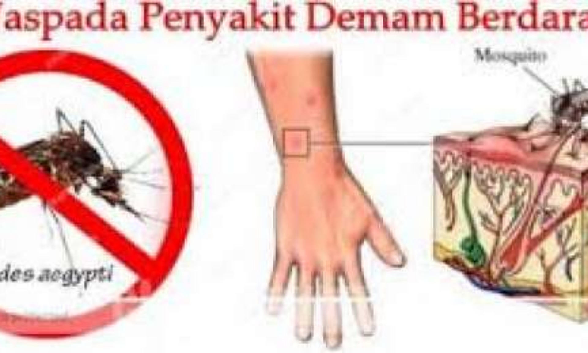 Awal Bulan Mei, Kasus DBD Paling Banyak di Sukajadi