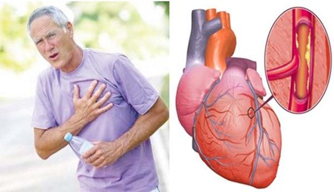 4 Kebiasaan Sepele ini Picu Kerusakan Jantung